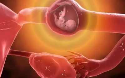 بارداری خارج از رحم