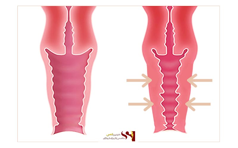 لیفت واژن با نخ چیست و چگونه انجام میشود