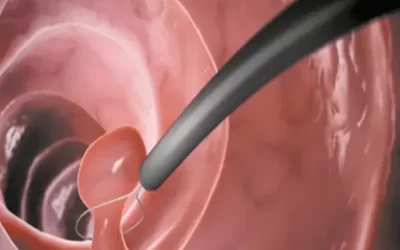 درمان ناباروری با هیستروسکوپی