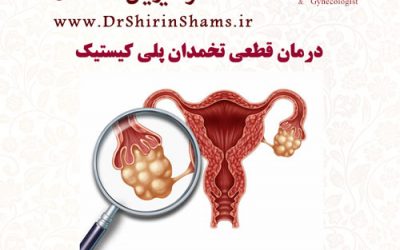 درمان قطعی تخمدان پلی کیستیک