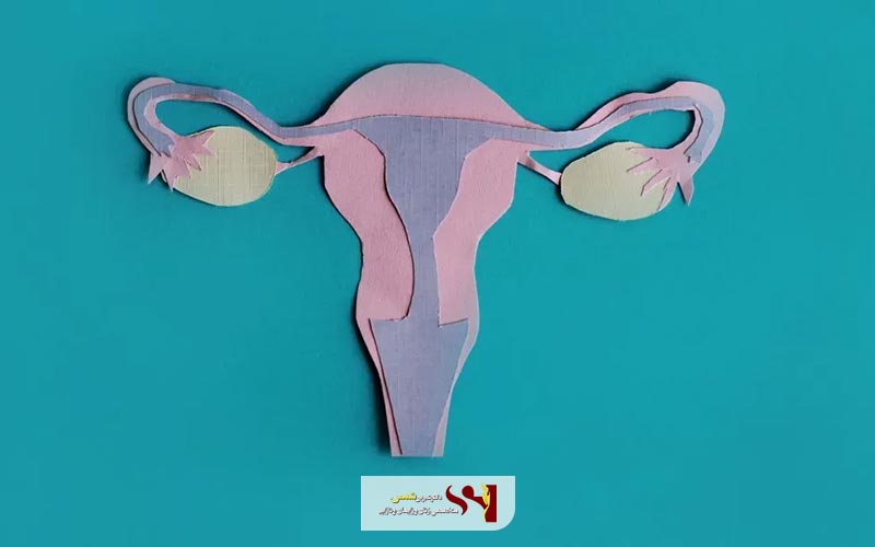 کیست ساده یا فولیکولی از انواع کیست تخمدان