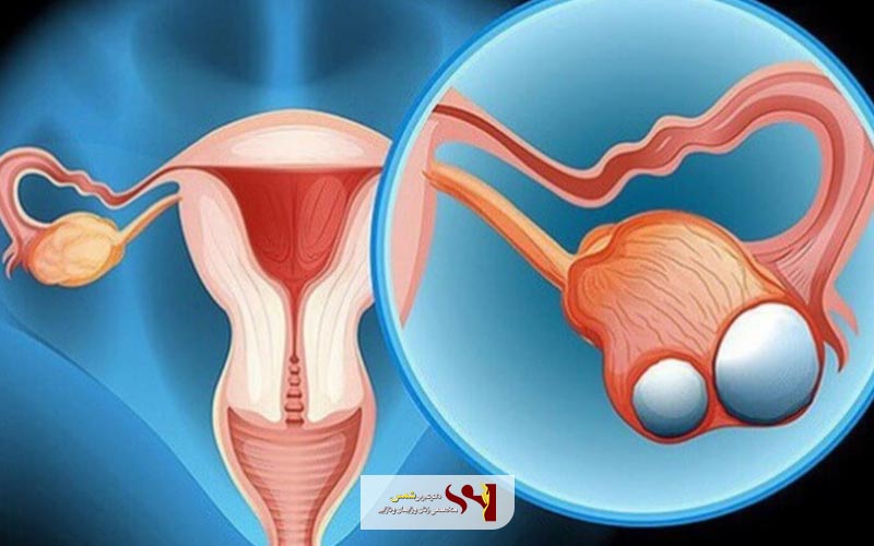 کیست تخمدان یا Ovarian Cysts چیست و چه نشانه هایی دارد