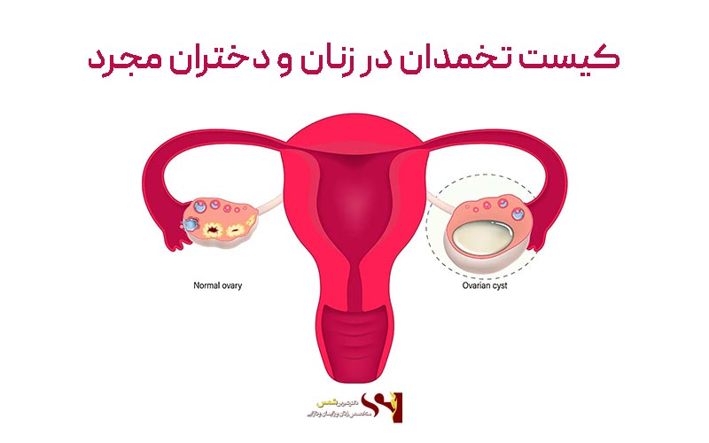 کیست فولیکولار از انواع کیست‌های تخمدان دختران و زنان