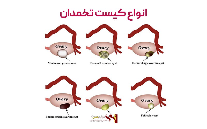 انواع کیست تخمدان در دختران مجرد و زنان کدام است