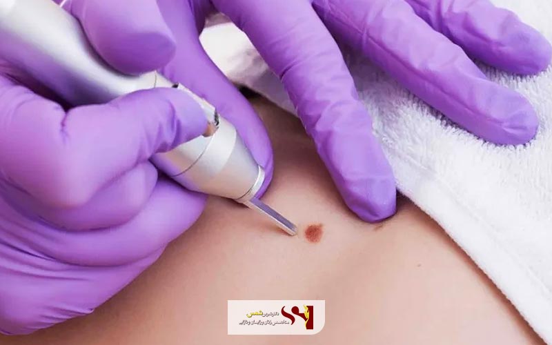 لیزر یکی دیگر از راه های درمان سریع و راحت انواع زگیل تناسلی است