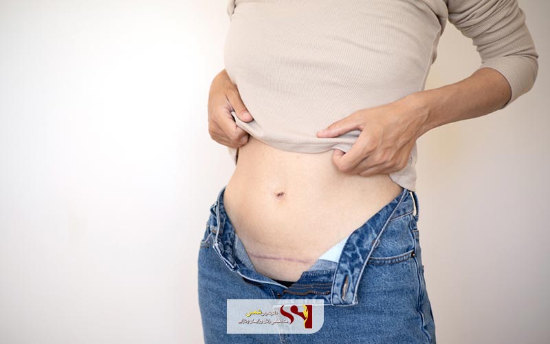 چه دلایلی باعث زایمان سزارین زودتر از موقع تعیین شده میشود