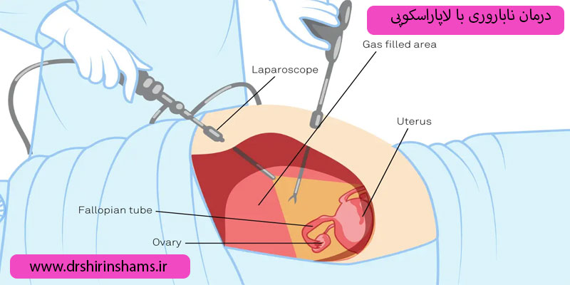 درمان-نازایی-با-لاپاراسکوپی