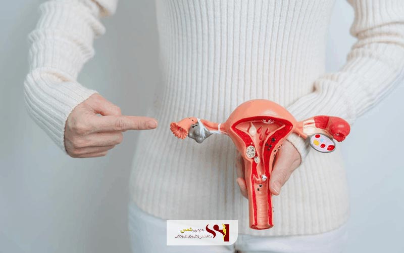 روش تشخیص افتادگی رحم به طور دقیق