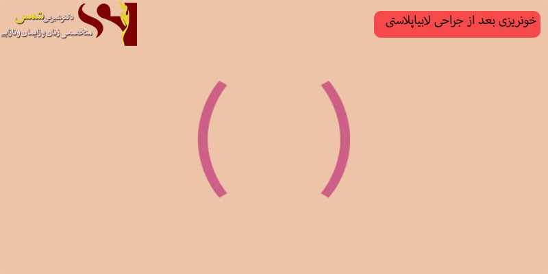 خونریزی-بعد-از-لابیاپلاسستی