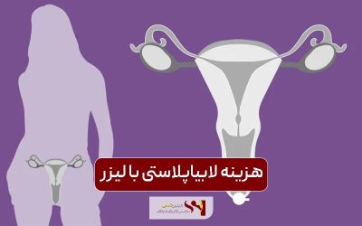 هزینه لابیاپلاستی با لیزر در سال 1404