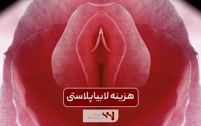 هزینه لابیاپلاستی و فاکتورهای موثر