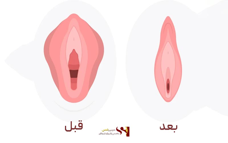 آشنایی با انواع عمل جراحی زیبایی واژن زنان