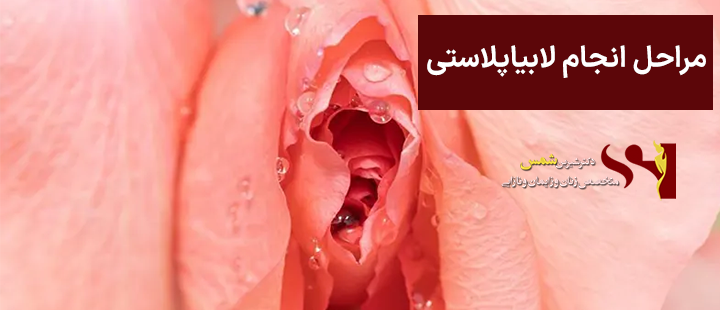 مراحل انجام لابیاپلاستی