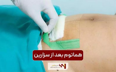 هماتوم بعد از سزارین